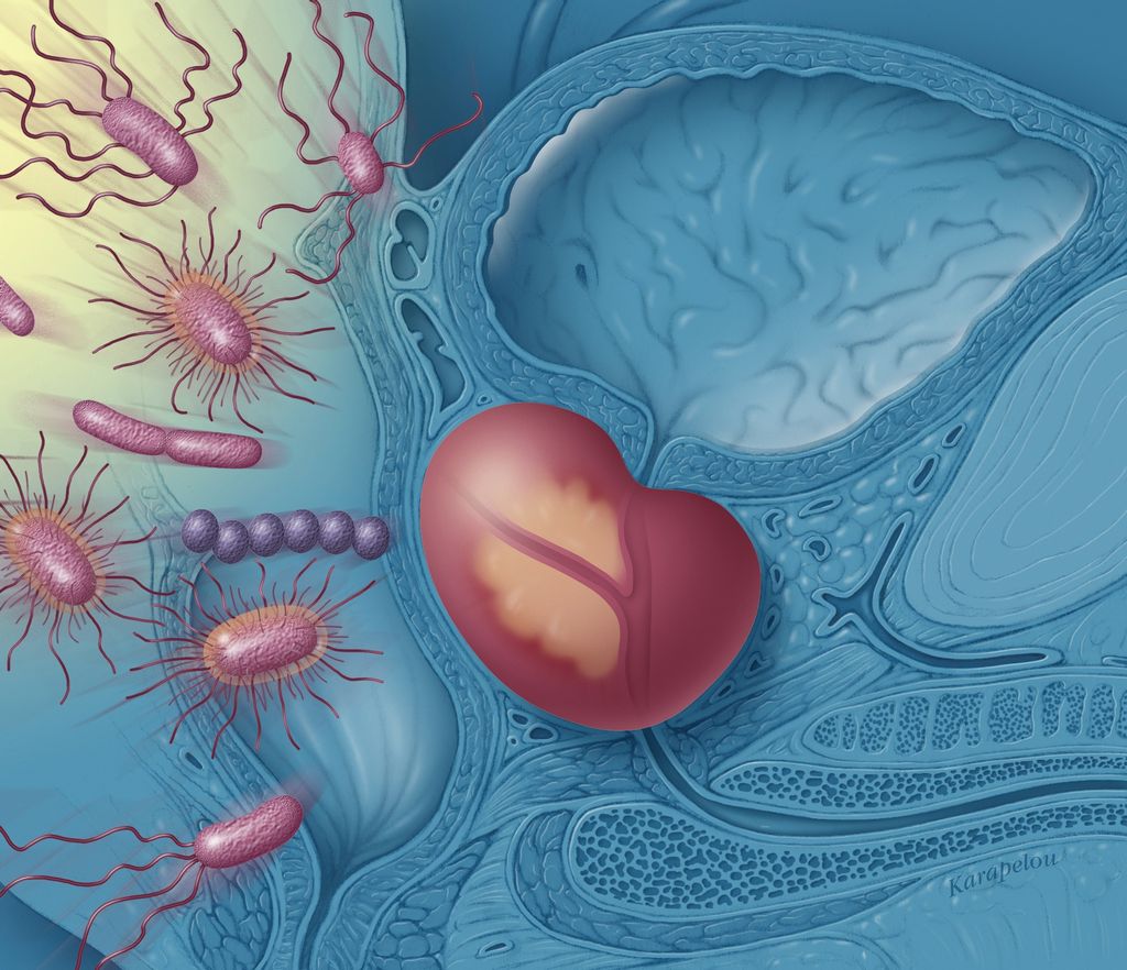 Una de las técnicas más eficaces para tratar la prostatitis